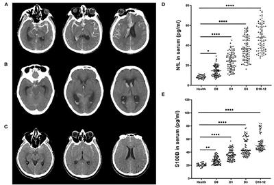 Neurofilament light chain and S100B serum levels are associated with disease severity and outcome in patients with aneurysmal subarachnoid hemorrhage